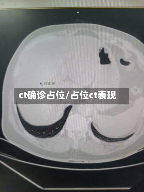 ct确诊占位/占位ct表现