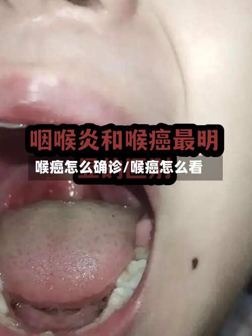 喉癌怎么确诊/喉癌怎么看-第3张图片
