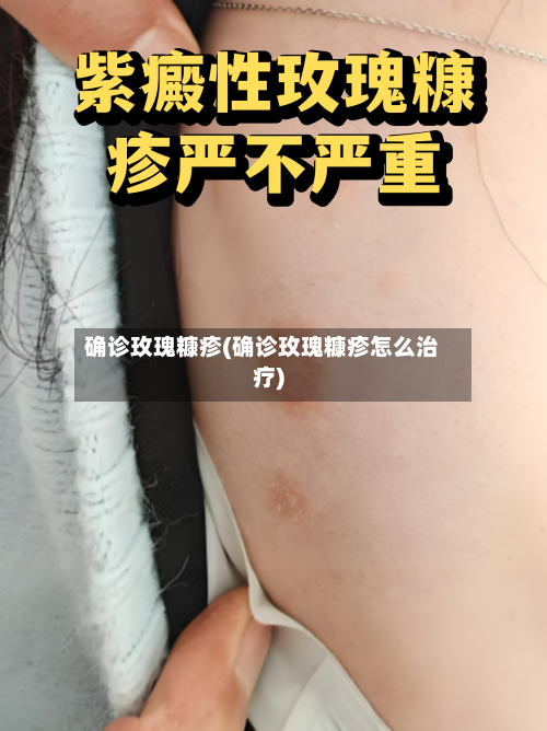 确诊玫瑰糠疹(确诊玫瑰糠疹怎么治疗)-第1张图片